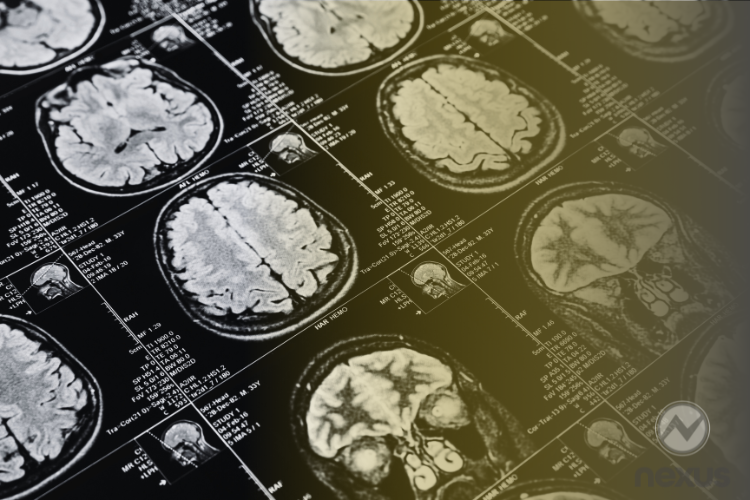 RM na esclerose múltipla